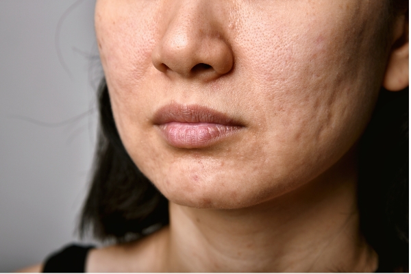 cómo eliminar las marcas de acné